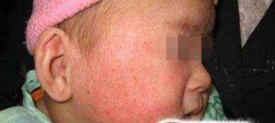 嬰兒乾性溼疹的預防與治療